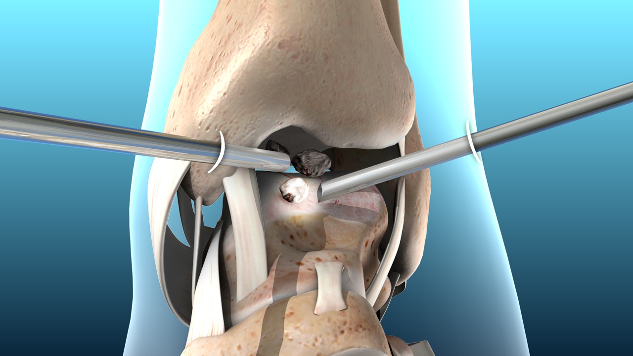 Ankle Ligament Reconstruction